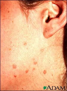 Warts, flat on the cheek and neck Warts, flat on the cheek and neck