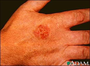Bowen's disease on the hand Bowen's disease on the hand