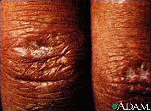 Dermatomyositis, Gottron's papule Dermatomyositis, Gottron's papule