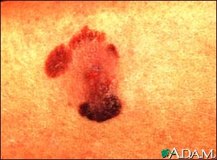 Skin cancer, malignant melanoma Skin cancer, malignant melanoma