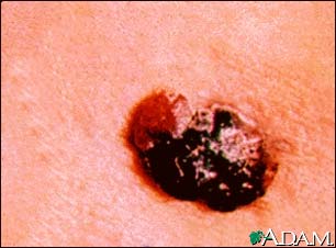 Skin cancer, raised multi-color melanoma Skin cancer, raised multi-color melanoma