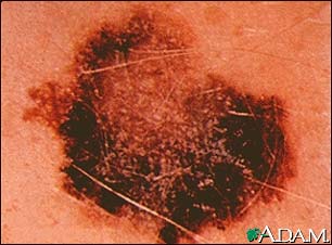 Skin cancer, melanoma - flat, brown lesion Skin cancer, melanoma - flat, brown lesion