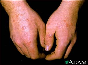 Erythema multiforme on the hands Erythema multiforme on the hands