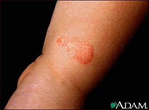 Ringworm, tinea corporis on an infant's leg Ringworm, tinea corporis on an infant's leg