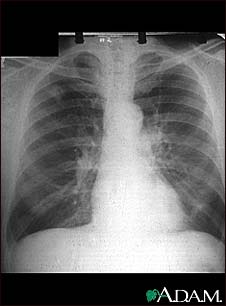 Adenocarcinoma - chest X-ray Adenocarcinoma - chest X-ray