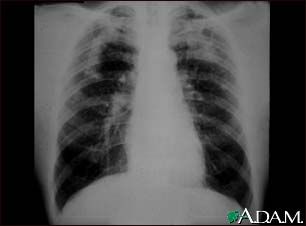 Coal workers pneumoconiosis, complicated Coal workers pneumoconiosis, complicated