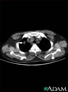Pulmonary nodule, solitary - CT scan Pulmonary nodule, solitary - CT scan
