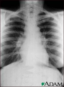 Sarcoid, stage I - chest X-ray Sarcoid, stage I - chest X-ray