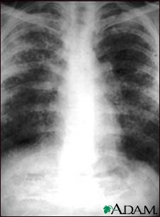 Sarcoid, stage II - chest X-ray Sarcoid, stage II - chest X-ray