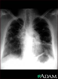 Sarcoid, stage IV - chest X-ray Sarcoid, stage IV - chest X-ray