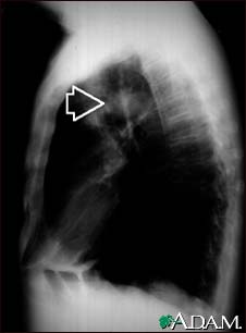 Pulmonary mass - side view chest X-ray Pulmonary mass - side view chest X-ray