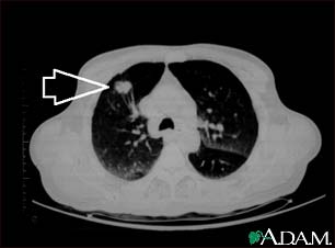 Lung mass, right upper lobe - CT scan Lung mass, right upper lobe - CT scan