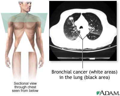Bronchial cancer - CT scan Bronchial cancer - CT scan
