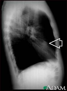 Lung nodule, right middle lobe - chest X-ray Lung nodule, right middle lobe - chest X-ray
