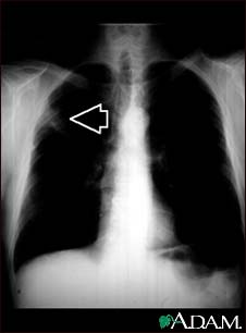 Lung mass, right upper lung - chest X-ray Lung mass, right upper lung - chest X-ray