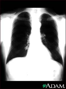 Lung nodule - front view chest X-ray Lung nodule - front view chest X-ray