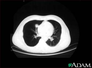 Lung nodule, right lower lung - CT scan Lung nodule, right lower lung - CT scan