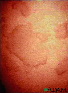 Hives (urticaria) - close-up Hives (urticaria) - close-up