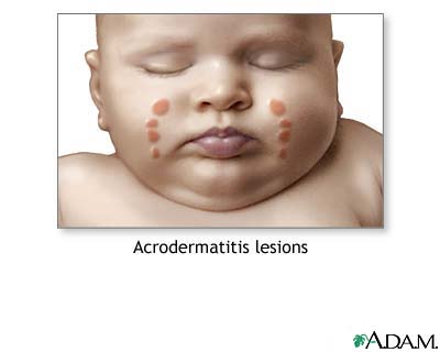 Acrodermatitis Acrodermatitis