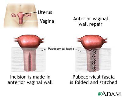 Anterior vaginal wall repair Anterior vaginal wall repair