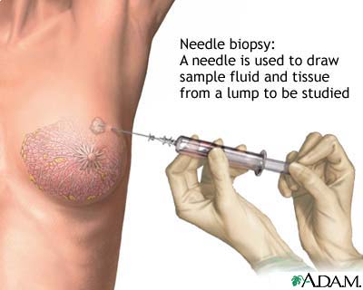 Needle biopsy of the breast Needle biopsy of the breast