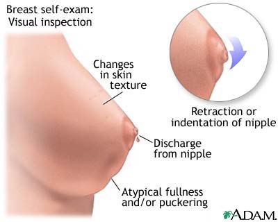 Breast self-exam Breast self-exam