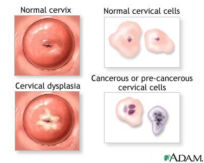 Cervical neoplasia Cervical neoplasia