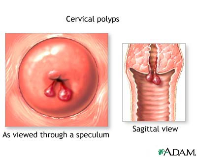 Cervical polyps Cervical polyps