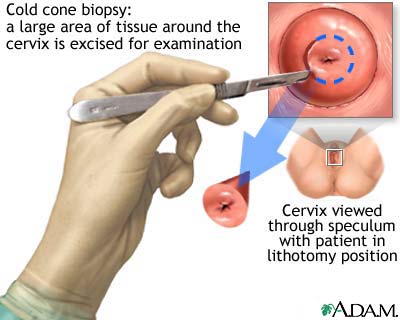 Cold cone biopsy Cold cone biopsy