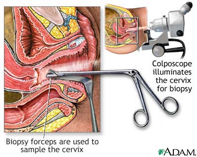 Colposcopy-directed biopsy Colposcopy-directed biopsy