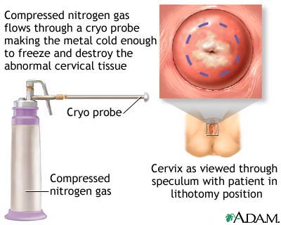 Cervical cryosurgery Cervical cryosurgery