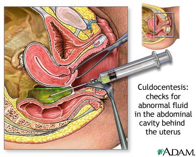 Culdocentesis Culdocentesis