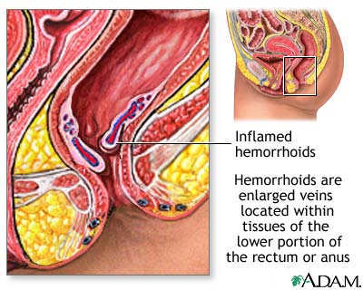 Hemorrhoids Hemorrhoids