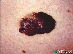 Skin cancer, melanoma - raised, dark lesion Skin cancer, melanoma - raised, dark lesion