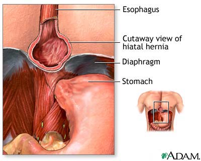 Hiatal hernia Hiatal hernia
