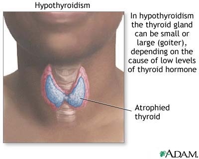 Hypothyroidism Hypothyroidism