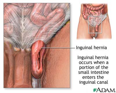 Inguinal hernia Inguinal hernia