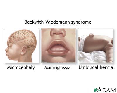 Beckwith-Wiedemann syndrome Beckwith-Wiedemann syndrome
