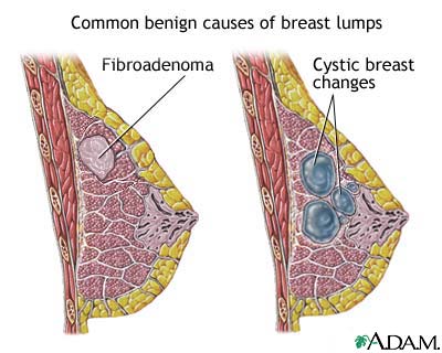 Causes of breast lumps Causes of breast lumps