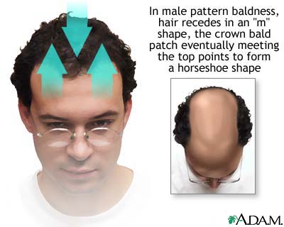 Male pattern baldness Male pattern baldness