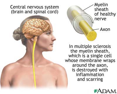 Multiple sclerosis Multiple sclerosis