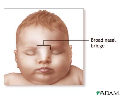 Broad nasal bridge Broad nasal bridge