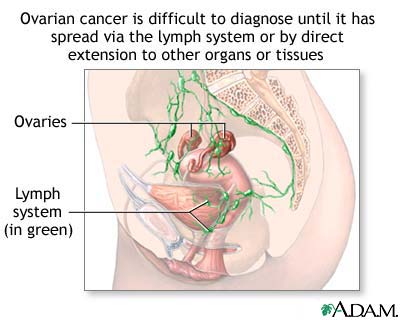 Ovarian cancer dangers Ovarian cancer dangers