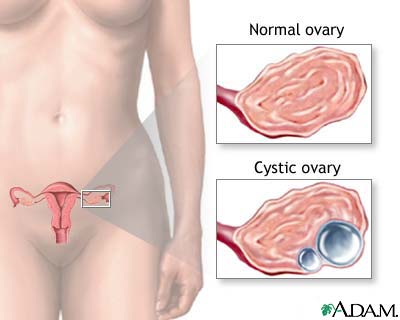 Ovarian cysts Ovarian cysts