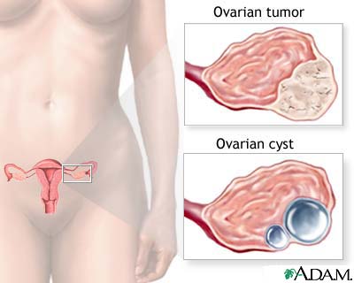 Ovarian growth worries Ovarian growth worries