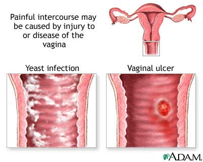 Causes of painful intercourse Causes of painful intercourse