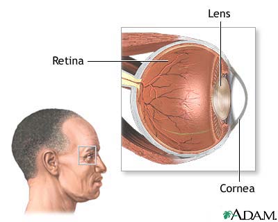 CMV retinitis CMV retinitis