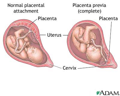 Placenta previa Placenta previa