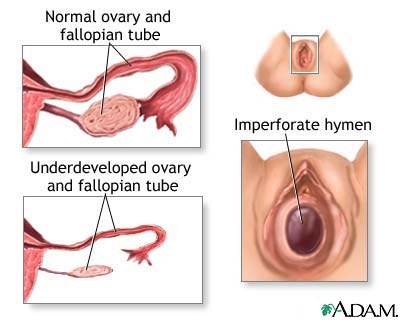 Primary amenorrhea Primary amenorrhea