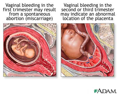 Vaginal bleeding during pregnancy Vaginal bleeding during pregnancy